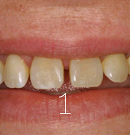 Carillas Dentales1