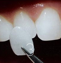Carillas Dentales3